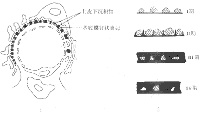 膜性肾小球肾炎示意图