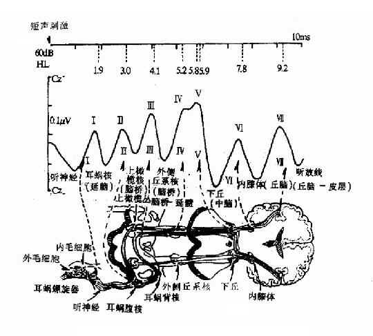 听性脑干反应典型七个波及来源示意图