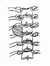 正位，椎旁软组织块影