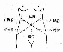 不同胎位的胎心音听取部位