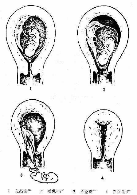 流产各阶段示意图