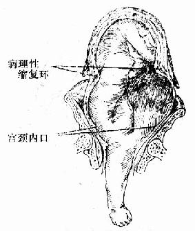 疏忽性横位,病理性缩复环形成