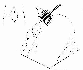 腹壁切口及取输卵管法