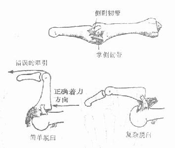 掌指关节脱位的手法复位