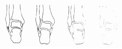 踝部韧带断裂与撕脱骨折