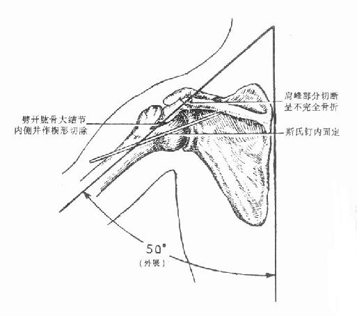 肩关节融合术示意图