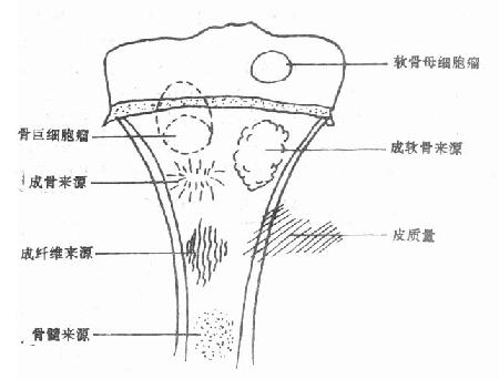 骨肿瘤好发部位