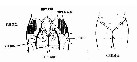 臀大肌肌内注射定位法