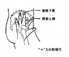 臀中肌、臀小肌注射定位法