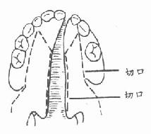 设计切口