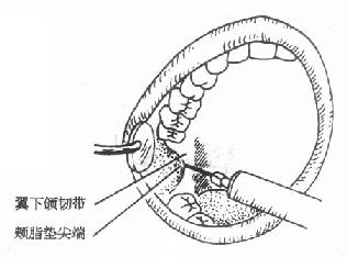 下牙槽神经阻滞麻醉穿刺点及方向