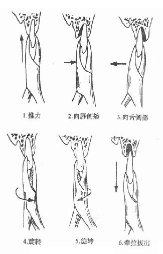 拔牙操作示意图