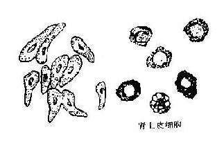 尿内常见的各种细胞