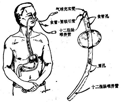  三腔胃造口管