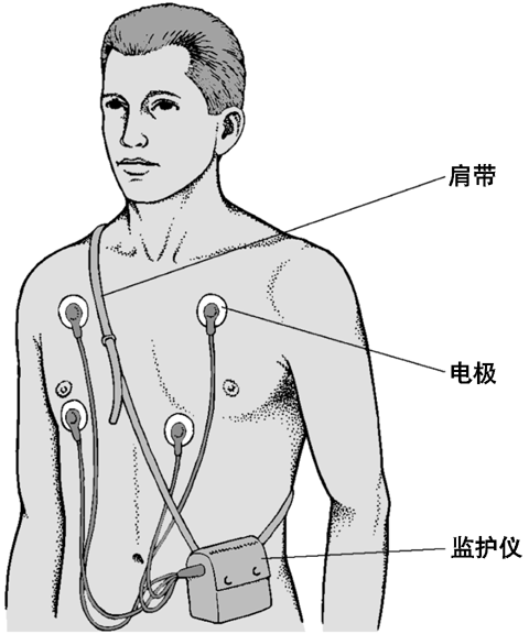 动态心电图持续的ECG记录