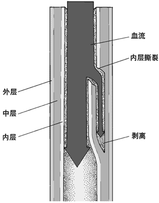 夹层动脉瘤