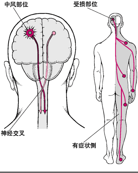 中风