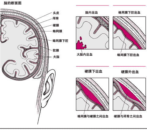 脑出血部位