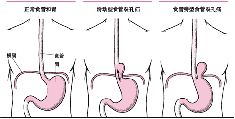 食管裂孔疝