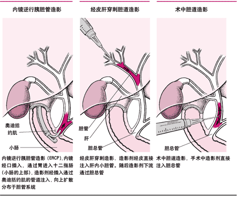 胆道诊断造影