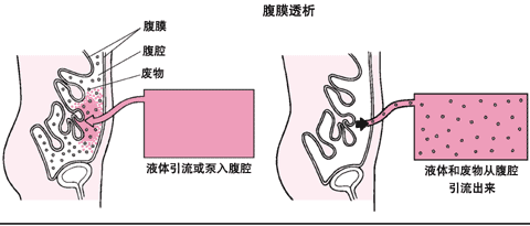 腹膜透析