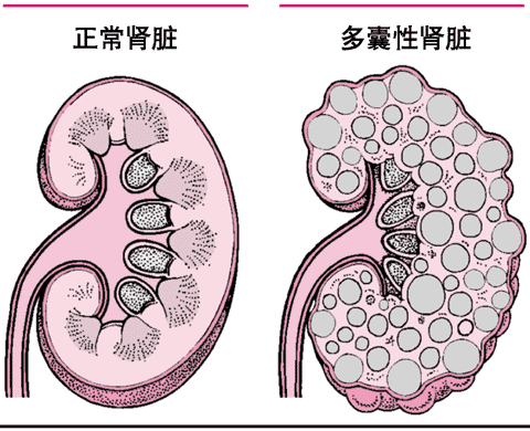 多囊性肾脏