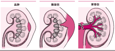 肾脏外伤