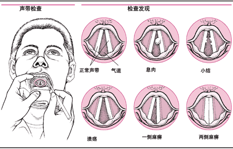 声带疾患