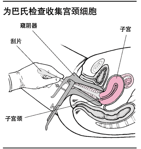 为巴氏检查收集宫颈细胞