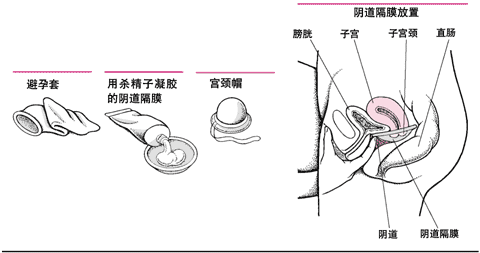 屏障避孕