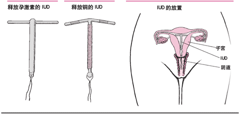 宫内节育器