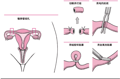 绝育