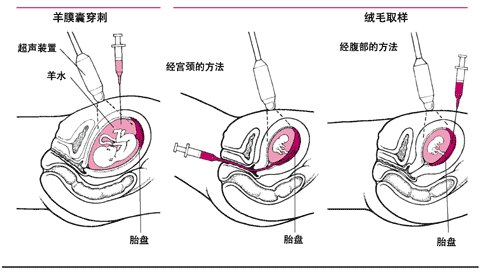 羊膜囊穿刺