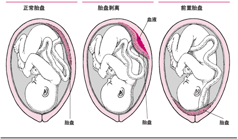 胎盘异常