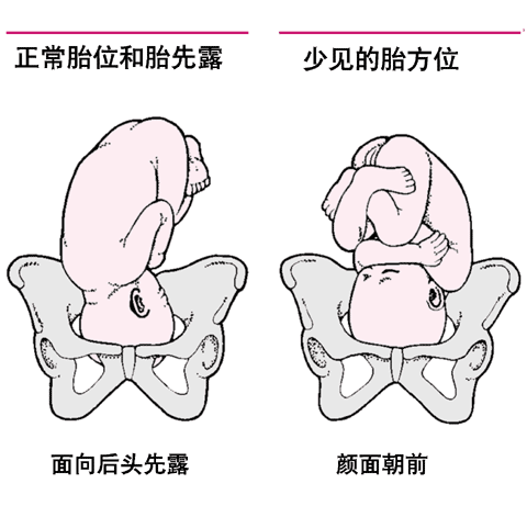 胎位异常