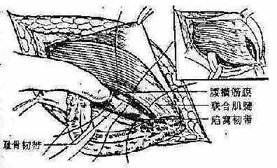 联合肌腱耻骨梳韧带缝合法