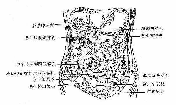 急性继发性腹膜炎的常见原因