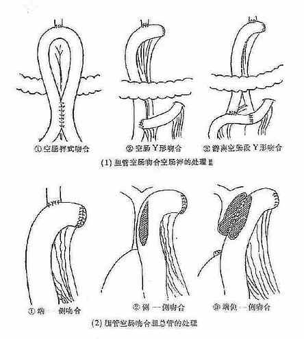 胆总管空肠多种形式吻合