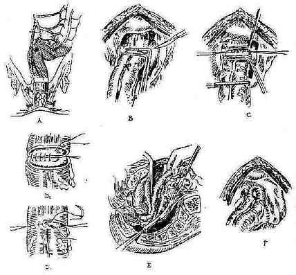 直肠前切除术（Dixon氏术）