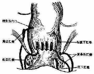 各种类型的肛瘘