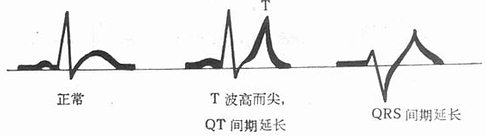 高钾血症的心电图变化