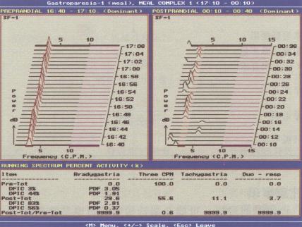 快速富里叶（Fourier）分析法进行EGG检查图例