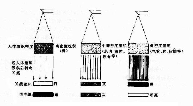 不同密度组织（厚度相同）与X线成像的关系